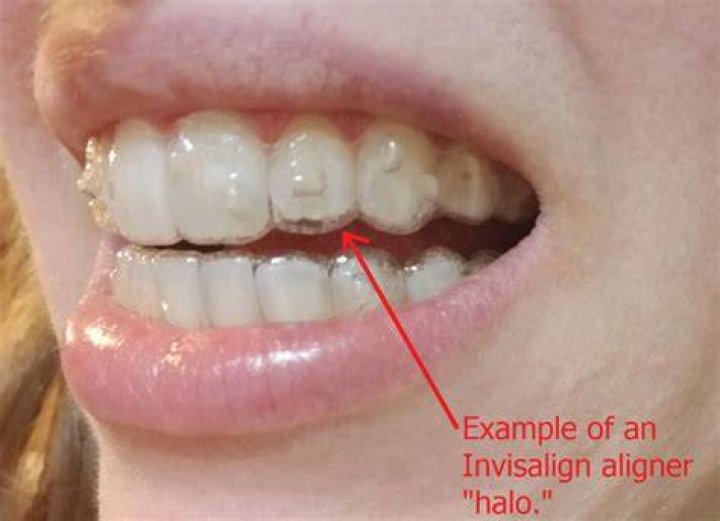 How Long Was B. Simone and Invisalign Together? A Comprehensive Look